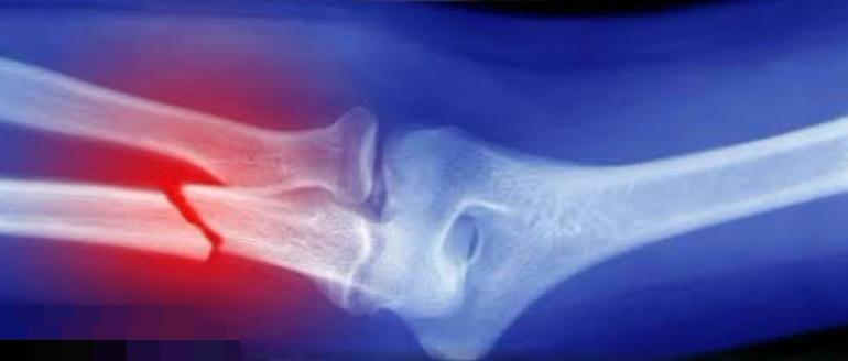 അസ്ഥിചികിത്സയില്‍ വിപ്ലവം: ‘Bone-02’ ഗ്ലൂ ചികിത്സ ചൈനയില്‍ വികസിപ്പിച്ചു.